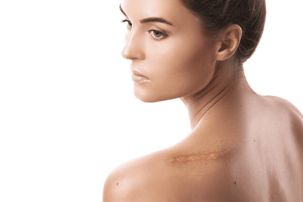 Scar Removal at Premier Medical Clinic