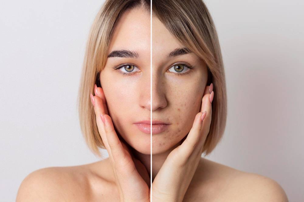 Acne Treatment at Premier Medical Clinic