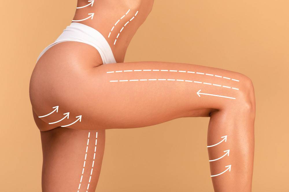Cellulite Reduction at Premier medical Clinic