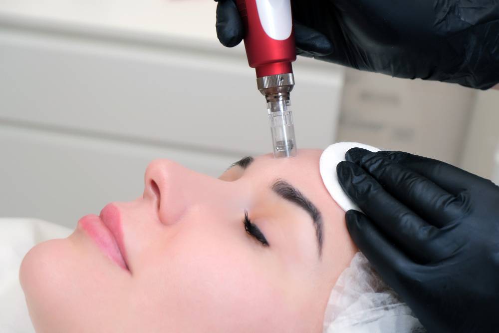 Microneedling: A Revolutionary Approach to Skin Rejuvenation