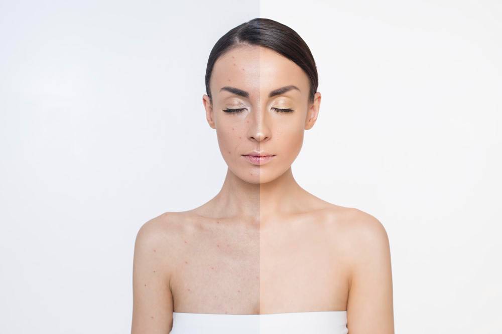 Pigmentation Correction at Premier Medical Clinic