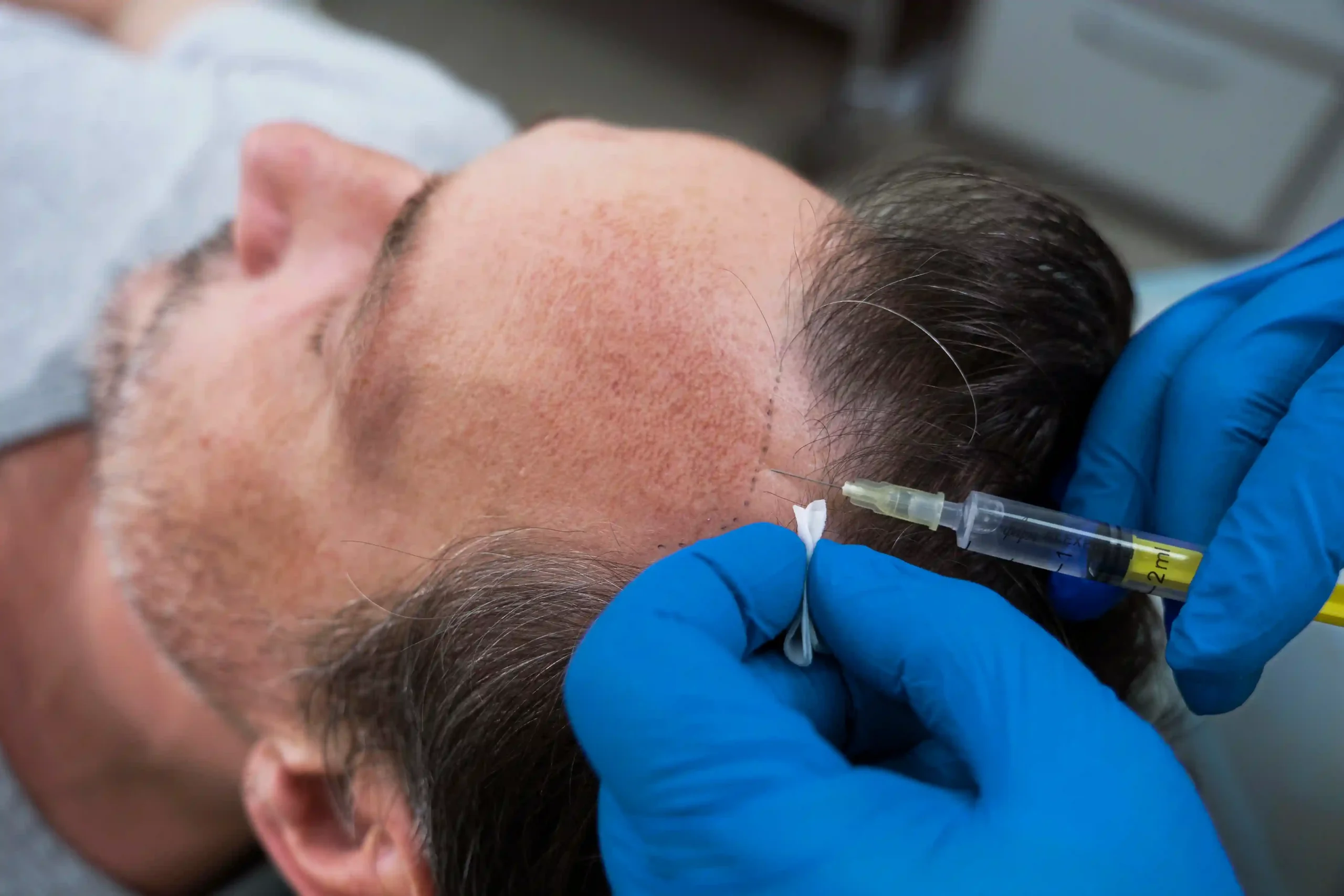 FUE Hair Transplant at Premier Medical Clinic