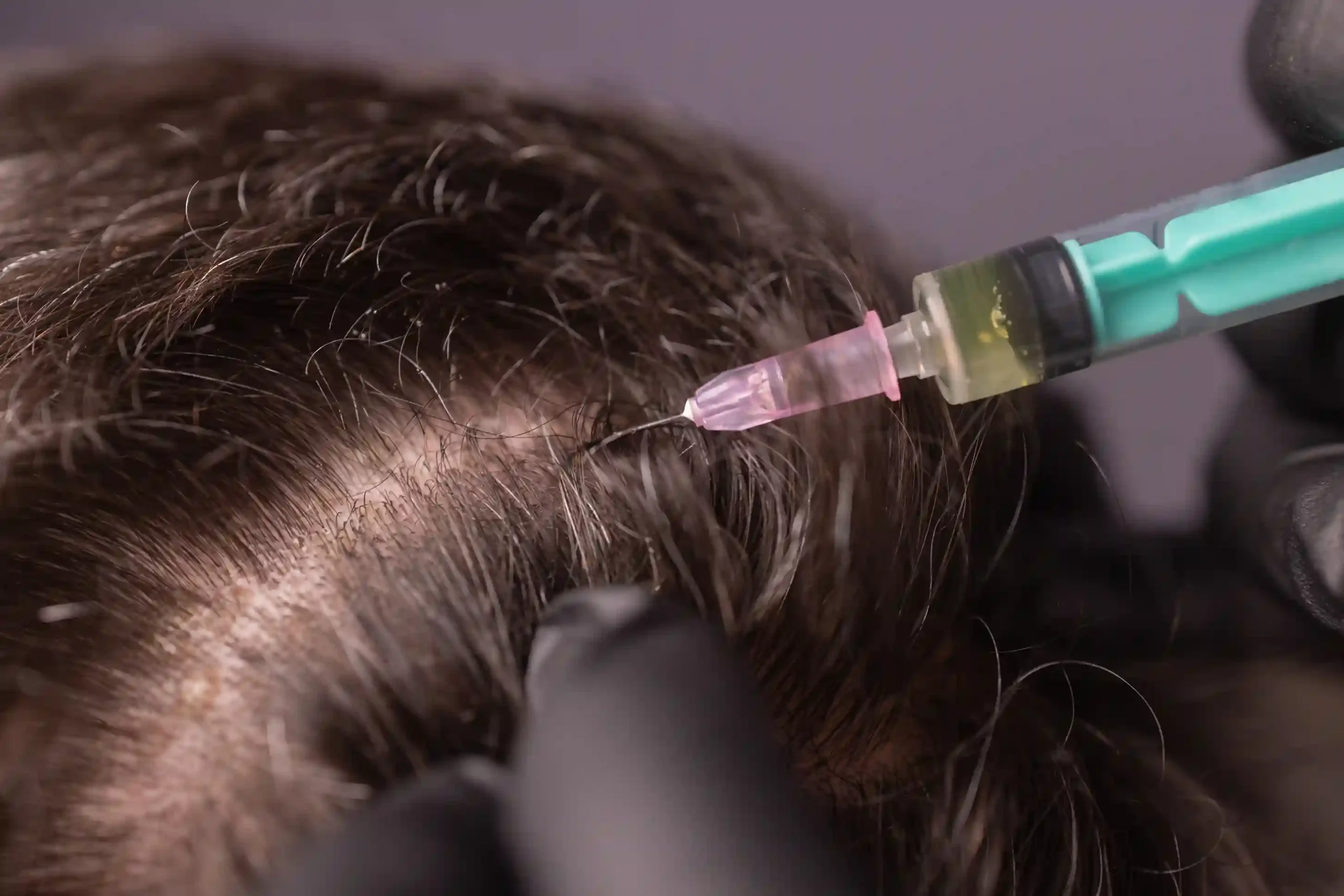 Hair Cloning & Stem Cell Therapy at Premier Medical Clinic