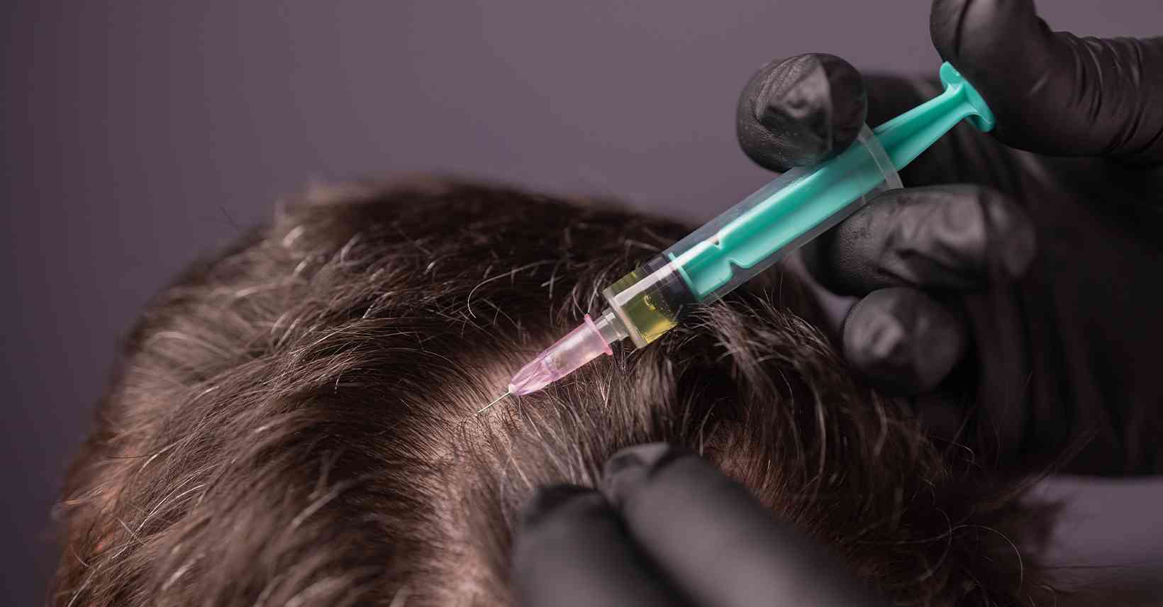 Non-Surgical Hair Restoration